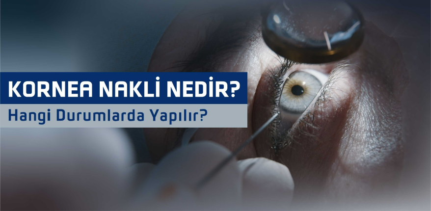 Kornea Nakli Nedir ve Hangi Durumlarda Yapılır?