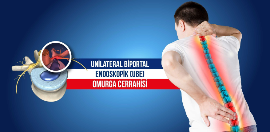 Unilateral Biportal Endoskopi ile gerçekleştirilen omurga ameliyatı sırasında yapılan minimal invaziv müdahale.