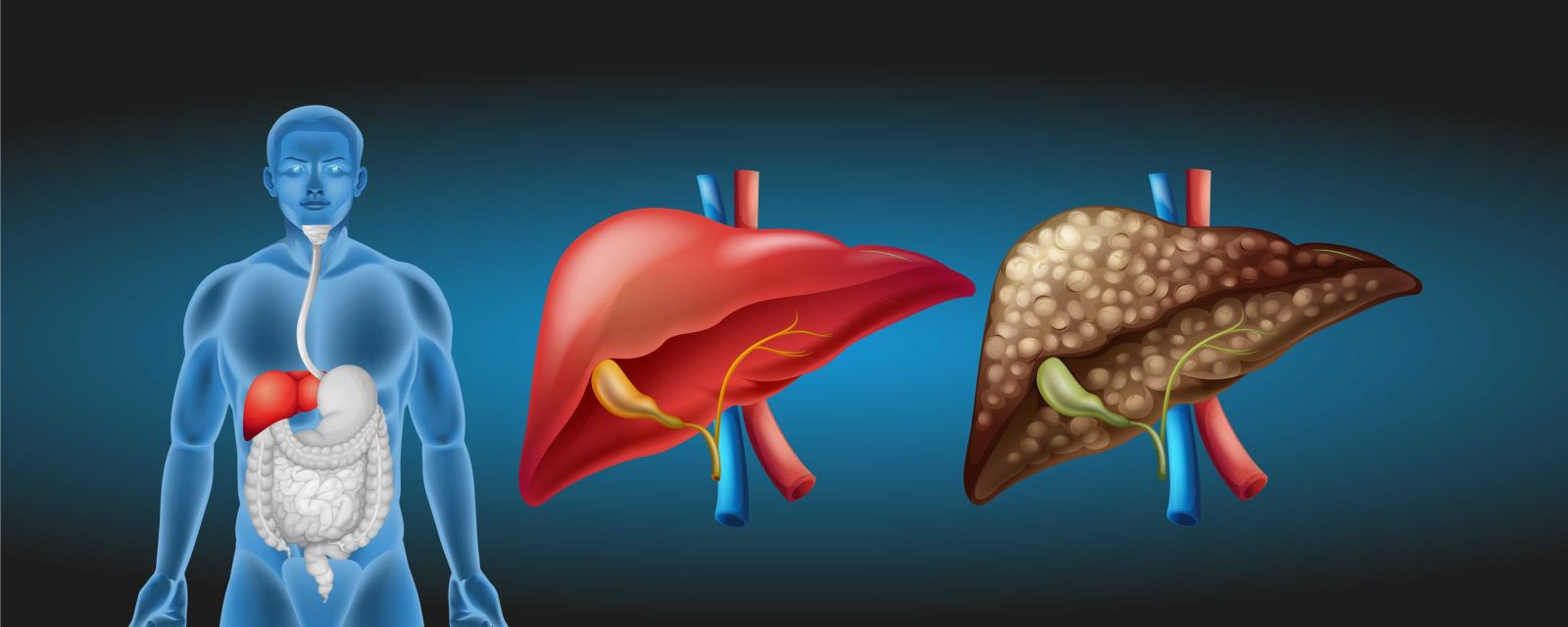 Siroz, karaciğer hücrelerinin uzun süreli ve tekrarlayan hasar sonucu meydana gelir.