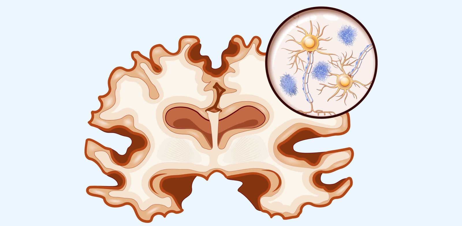 Alzheimer evreleri