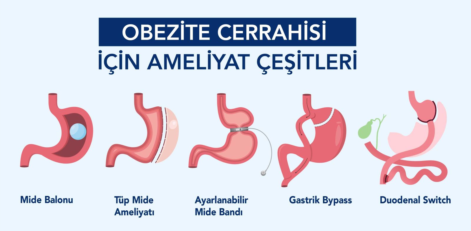 Obezite ameliyatları arasında en çok tüp mide ameliyatı ve mide balonu yapılır.