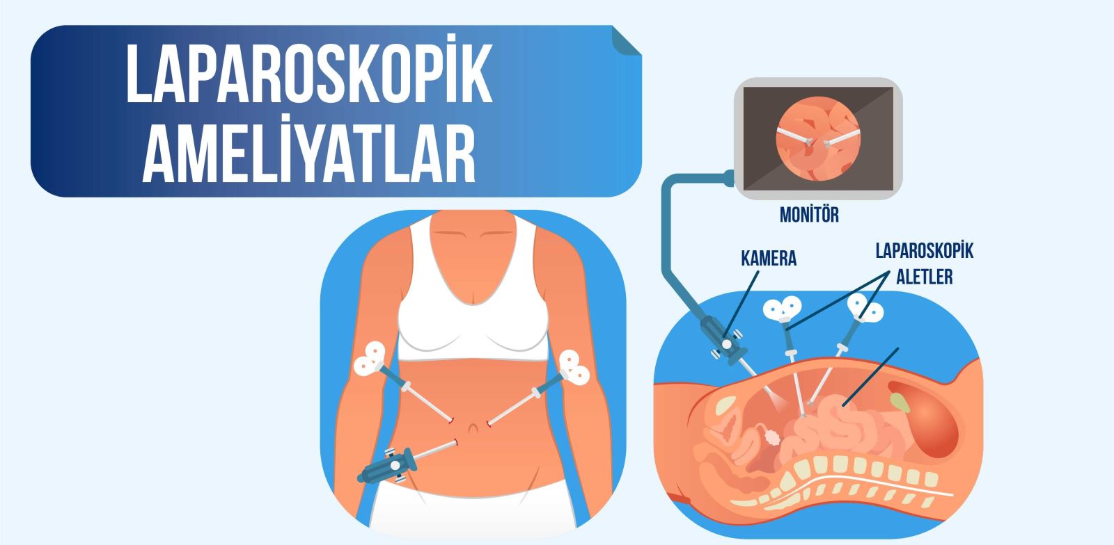 Laparoskopik apendektomi