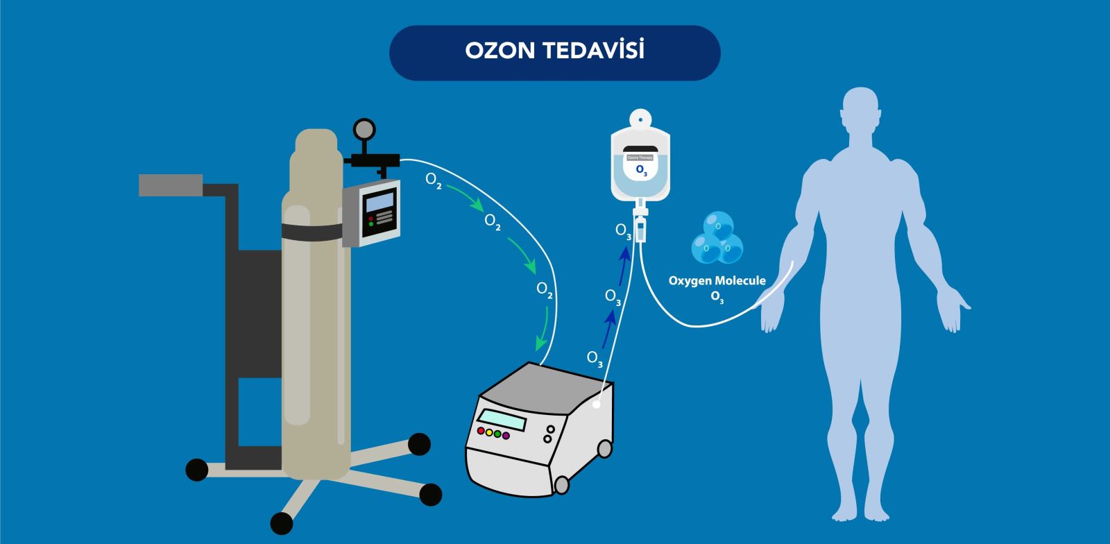 Ozon tedavisi uygulaması sırasında kullanılan yöntemler ve tedavi süreci