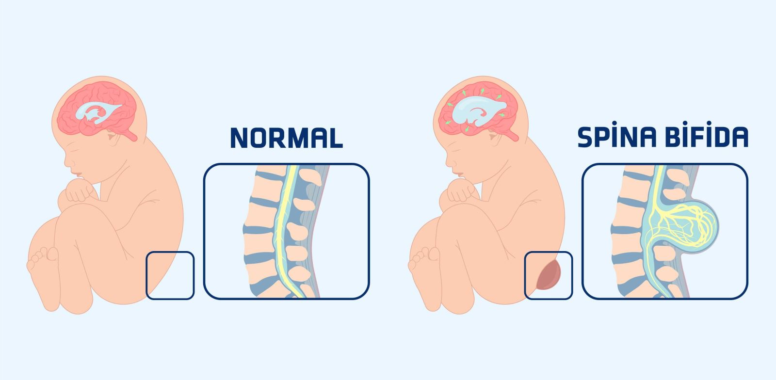 Spina bifida neden olur?