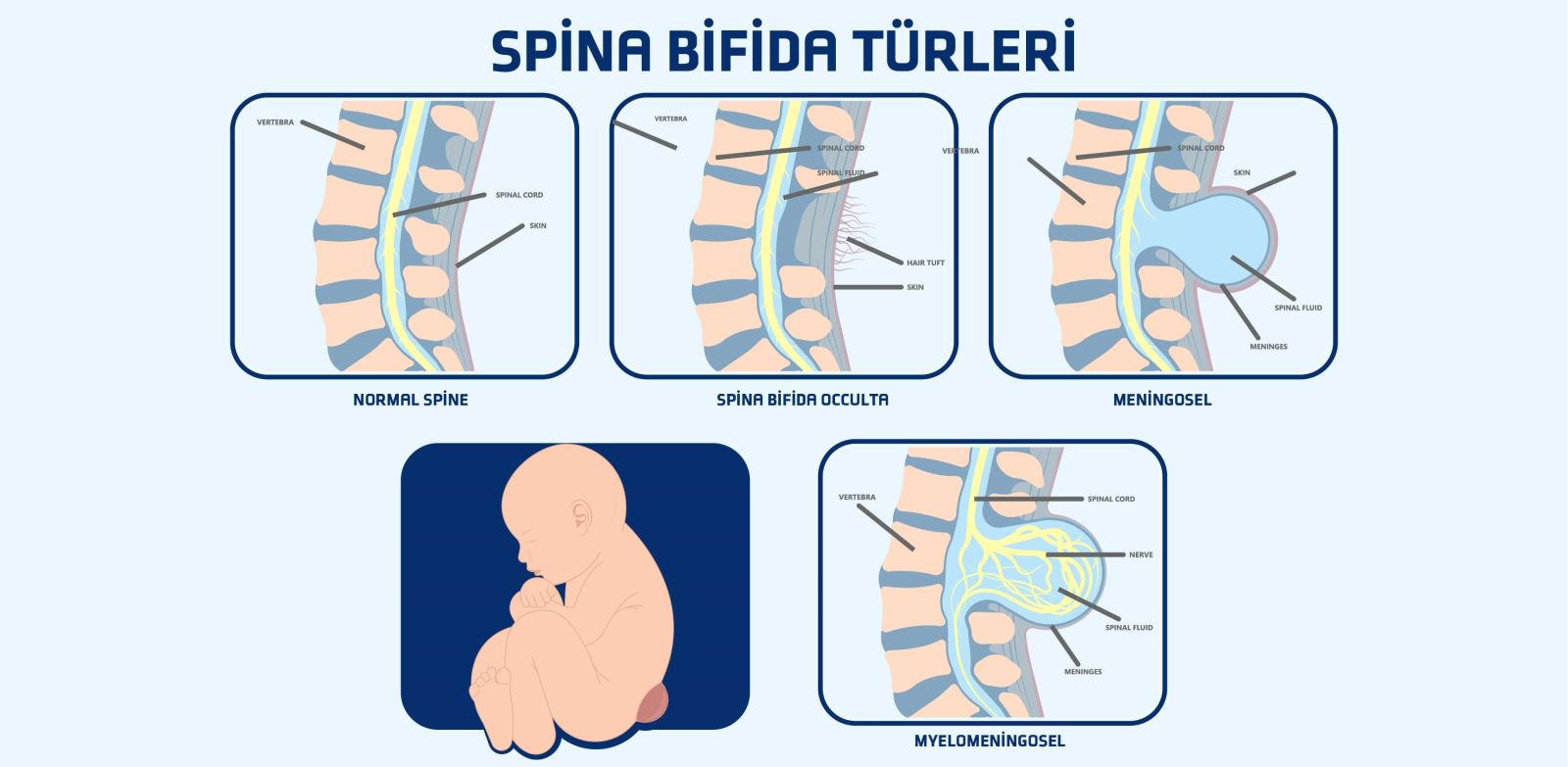 Spina bifida türleri