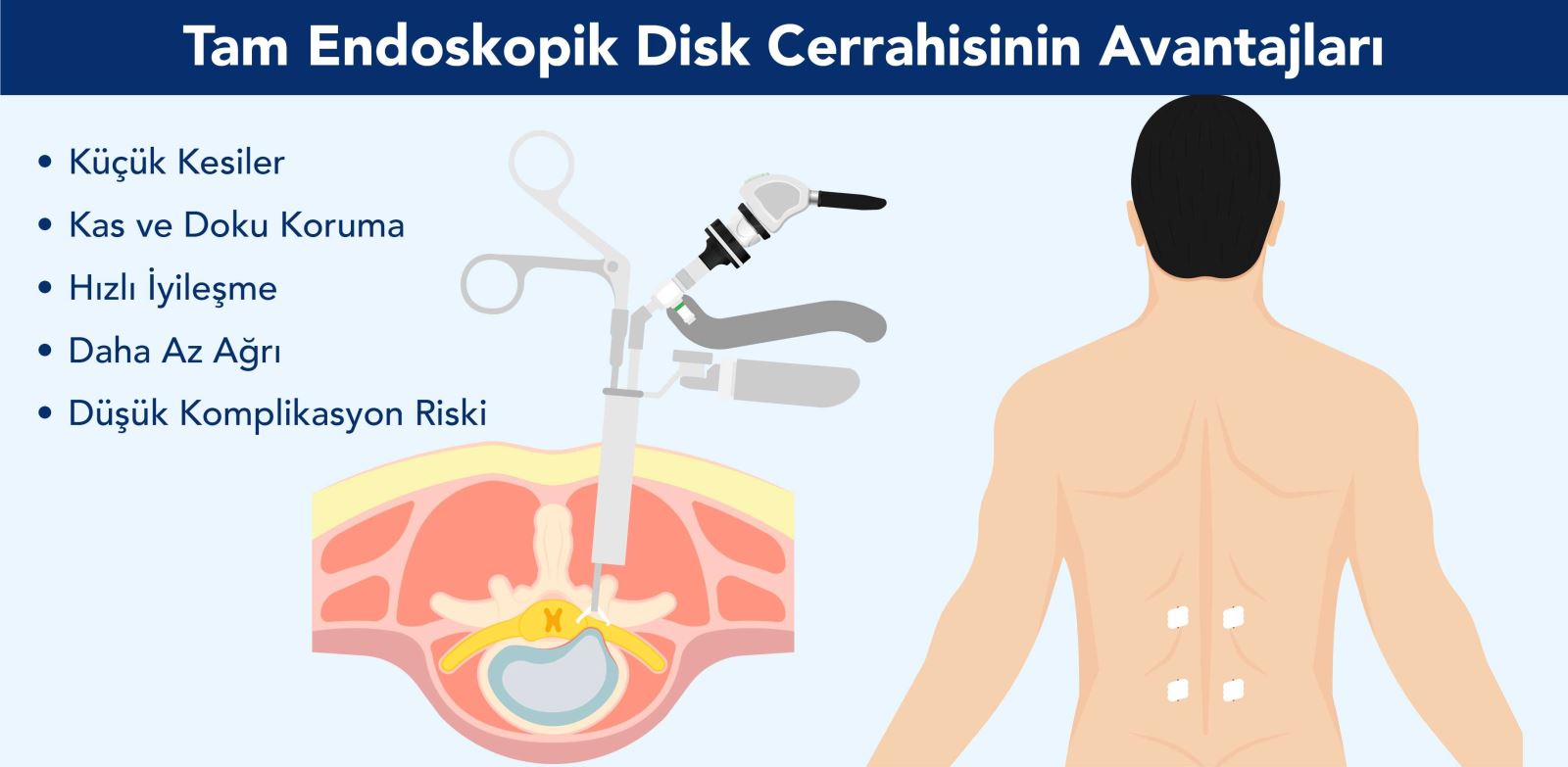 Tam Endoskopik Disk Cerrahisi, küçük kesi ve minimal ağrı ile omurga cerrahisinde avantaj sunar.