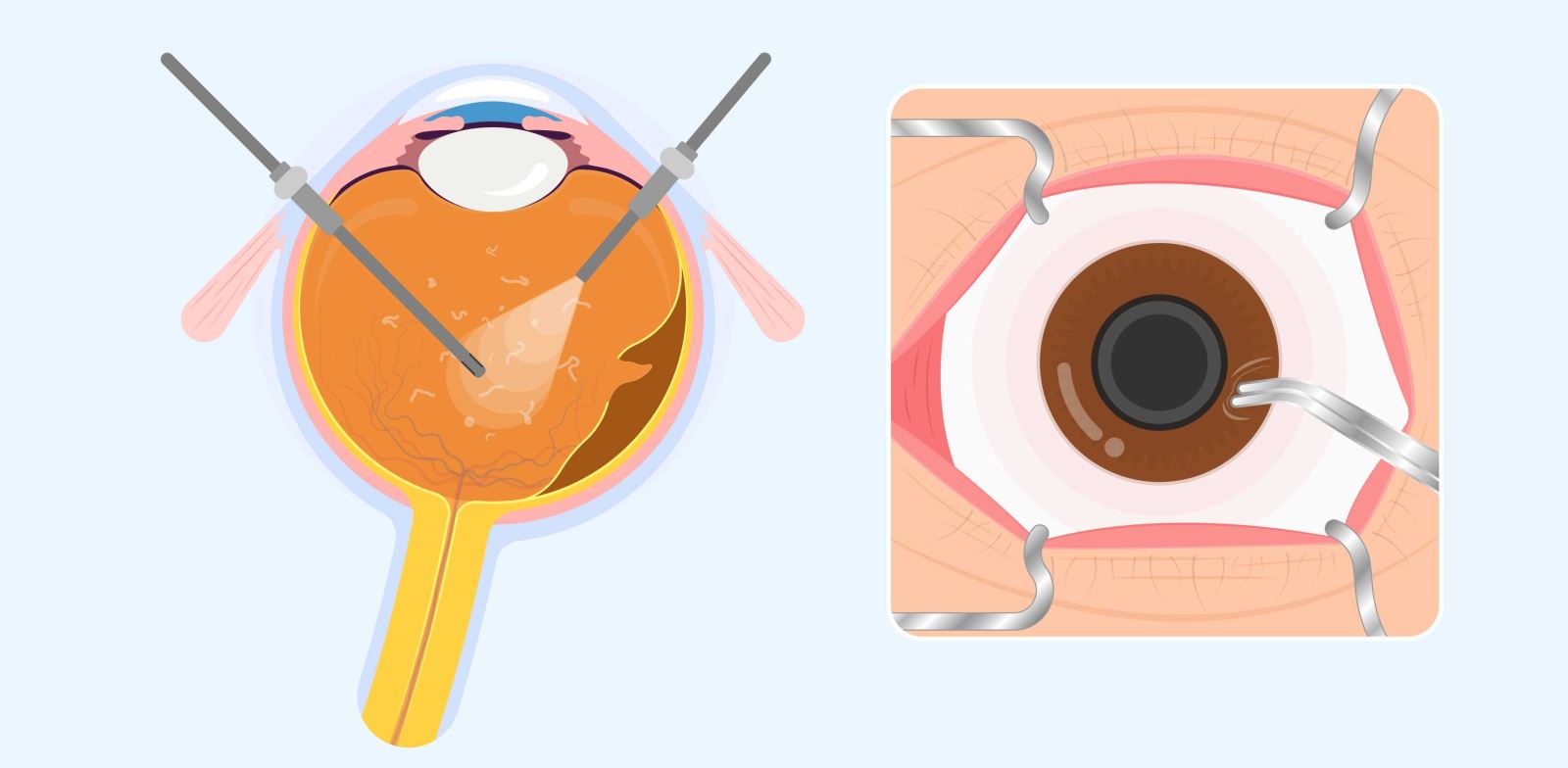 Vitrektomi nedir?